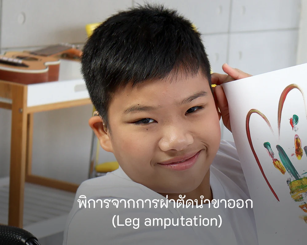 leg-amputation-disabilities